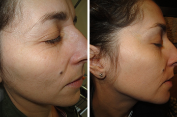 dermatología estética antes y después - clínica eguren