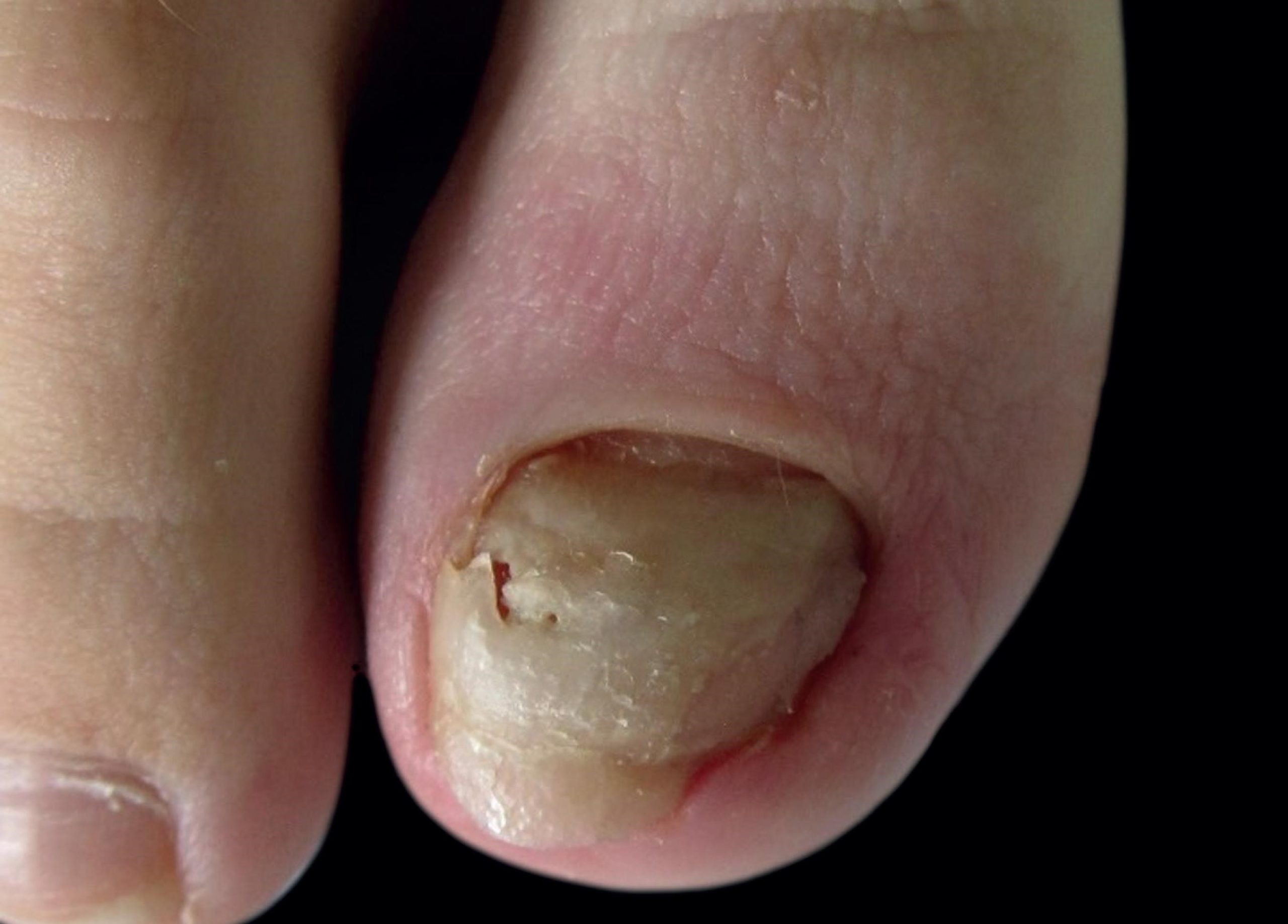  Cómo curar los hongos en las uñas de los pies  GRUPO PACC
