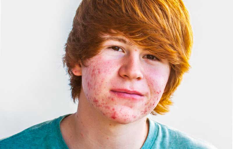Cómo afecta el acné psicológicamente a adolescentes y adultos