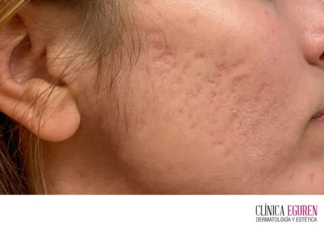 láser en el tratamiento de las cicatrices de acné