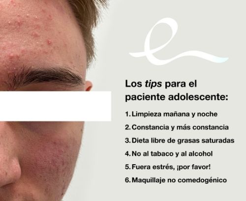 Tips para acné adolescente