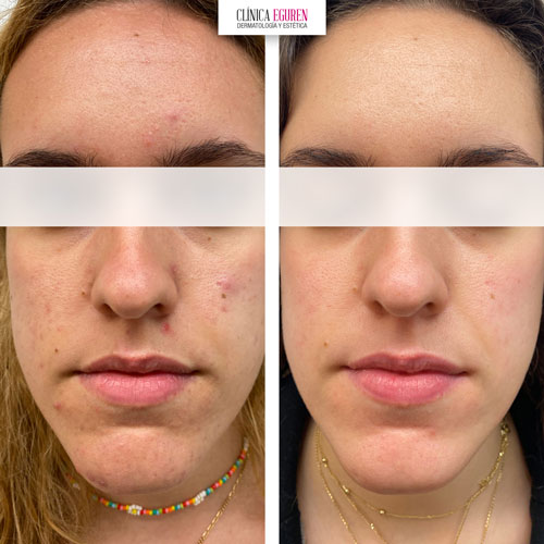 caso de acné severo antes y después