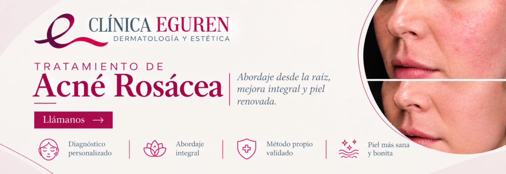 Banner Clínica Eguren: tratamiento de acné rosácea que calma la piel y reduce el enrojecimiento, antes y después